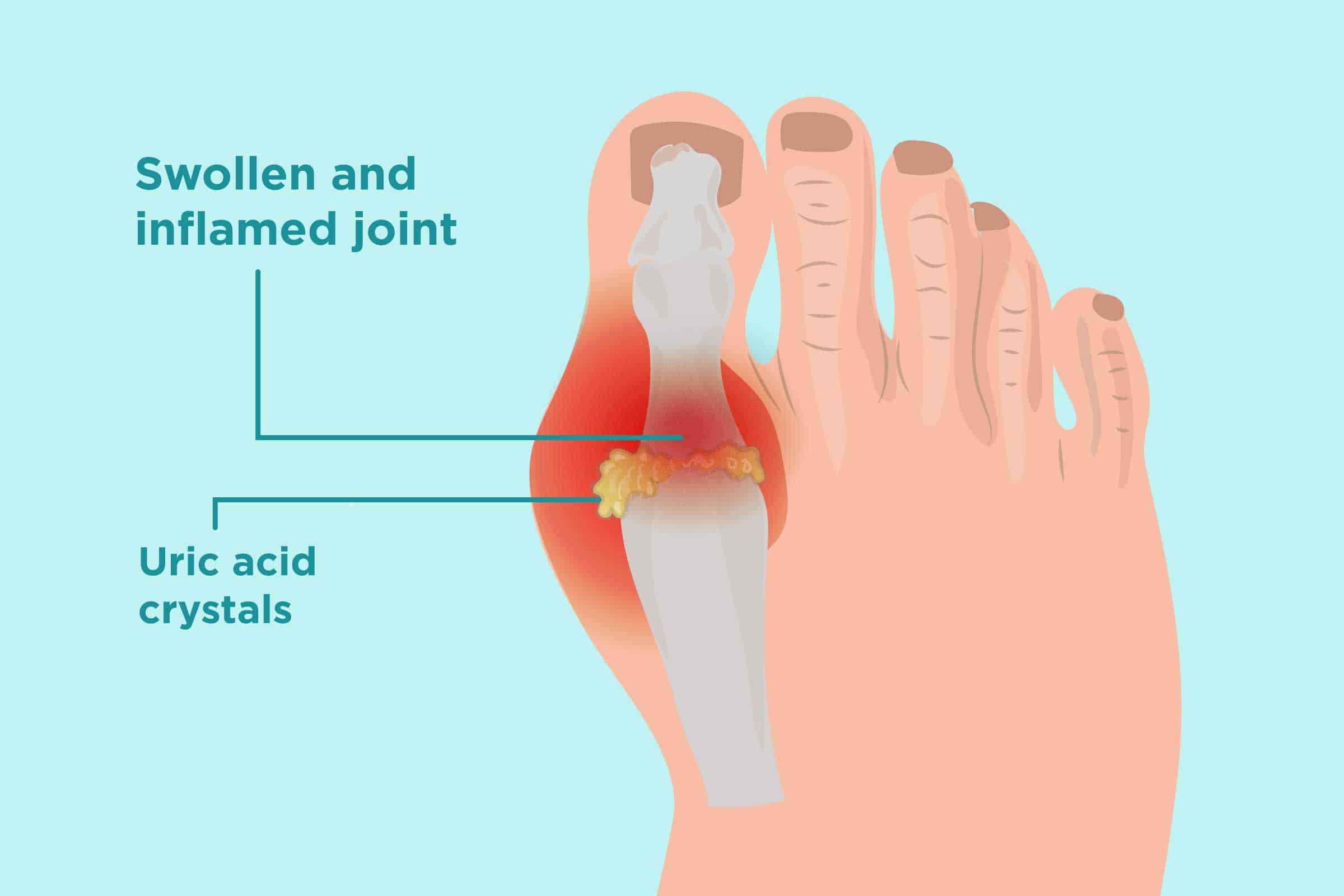 gout-high-uric-acid-levels-and-keto-ft-dr-ken-berry